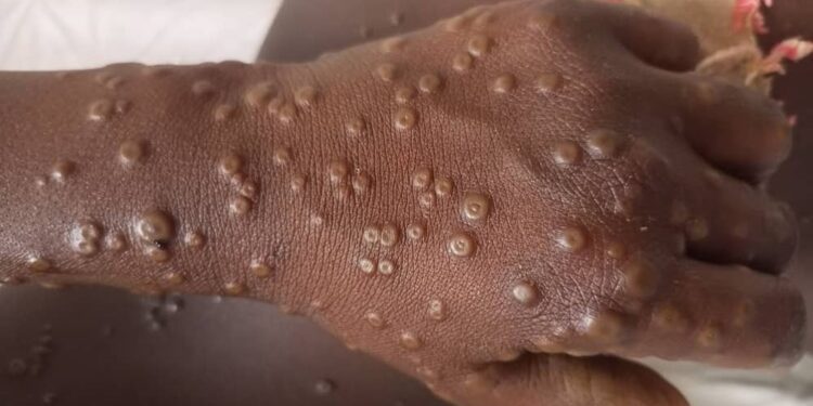 Dernière minute : la Guinée confirme son premier cas de Mpox