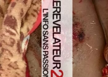 A Siguiri, un homme coupe ses organes génitaux : ‘’on a placé une sonde pour évacuer ses urines’’