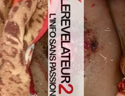 A Siguiri, un homme coupe ses organes génitaux : ‘’on a placé une sonde pour évacuer ses urines’’